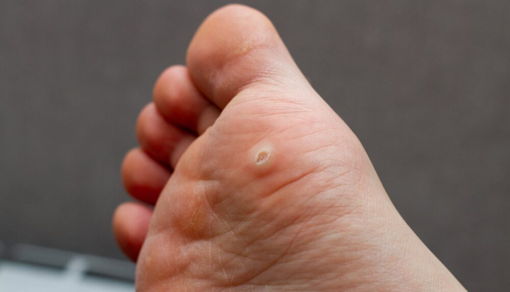 Plantar Warts